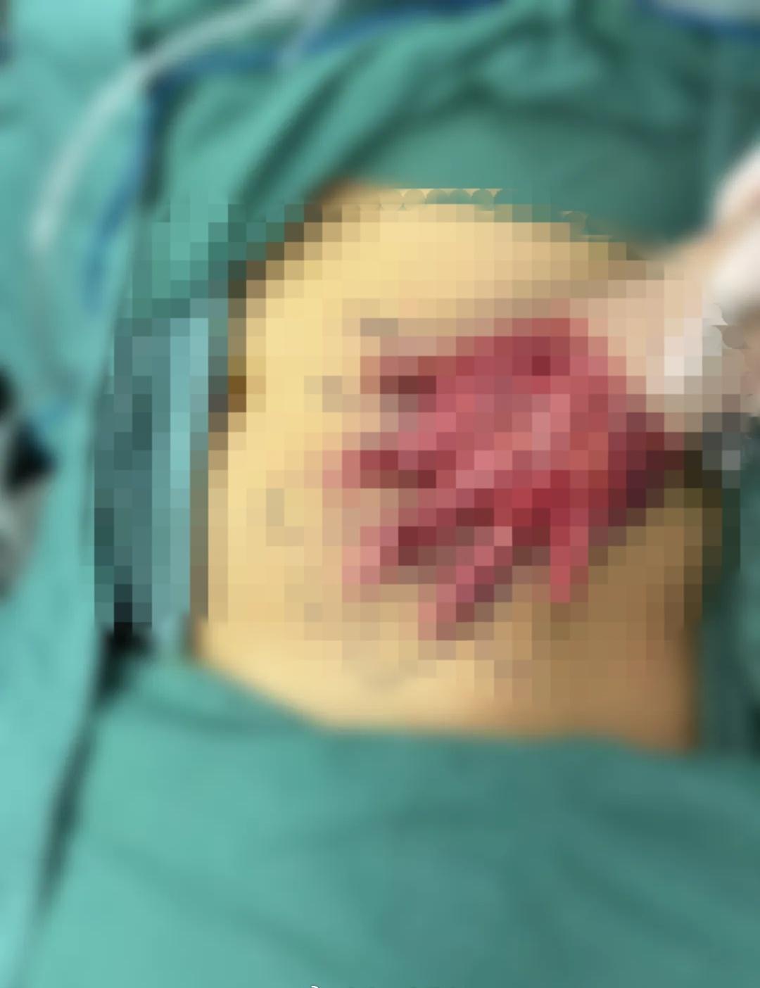 【热搜！断手“种”在肚子上！小伙左手被机械碾压严重损毁……最新进展！】春节假期进