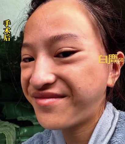 #女子称7万元做磨骨后火箭式衰老#看着就疼。想知道要是做了这个手术。脸不小心摔一