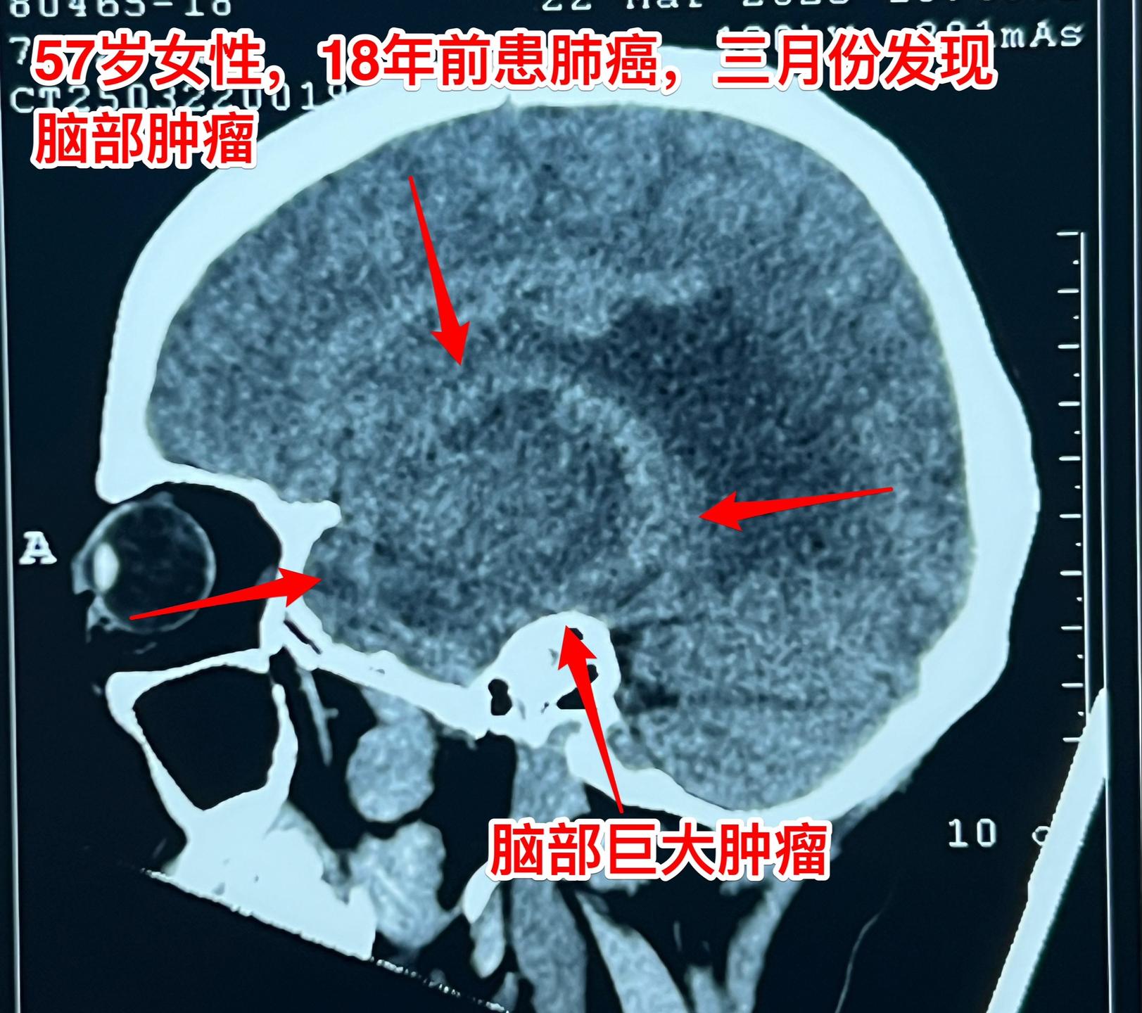 肺癌患者多年后出现脑部转移。57岁的韶关女病人在18年前患肺癌，作了手...