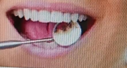 牙疼起来真要命，我来分享些立刻缓解的办法。要是外伤性牙疼或急性炎症初期，用冰袋或