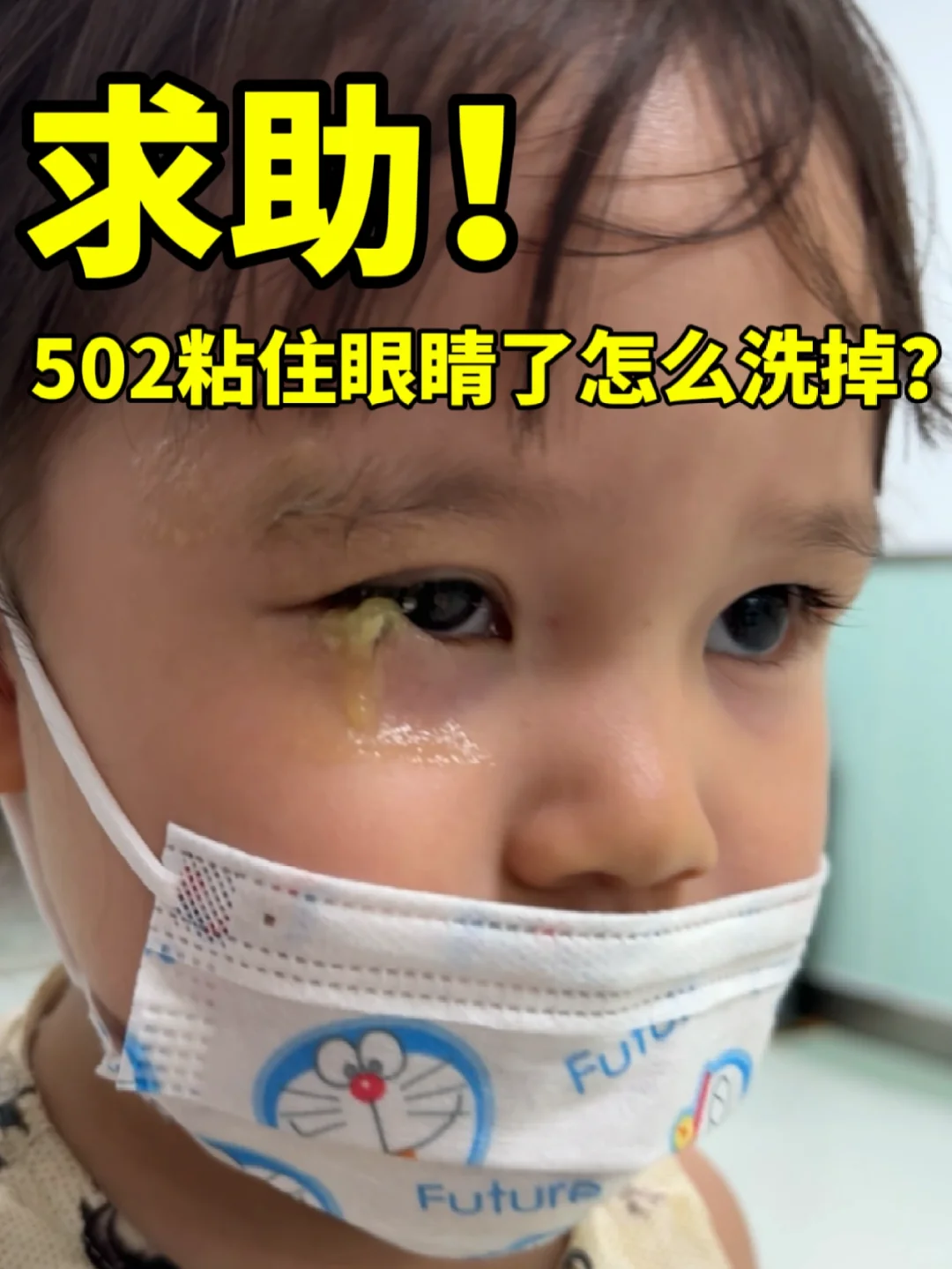 求助🙏万能的！502粘住眼睛怎么洗掉‼️