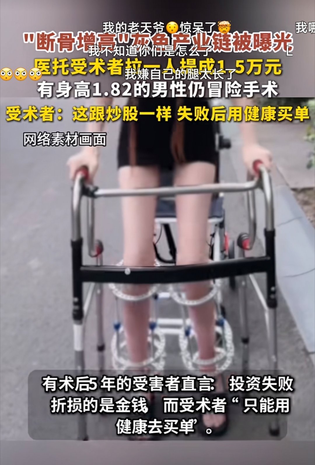 #男子身高一米八二仍做断骨增高#"断骨增高"灰色产业链，医托拉一人提成1.5万元