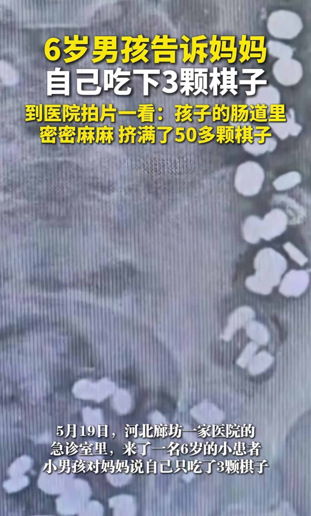 6岁孩子说吃了3颗棋子，一拍片竟然是50多颗。
有个6岁的孩子告诉妈妈自己吃了3
