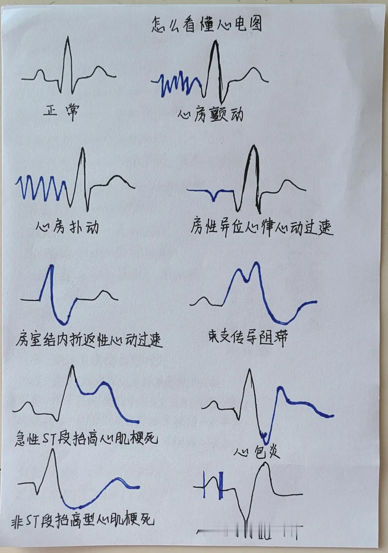 你还在为心电图的复杂波形感到困惑吗？今天，我将为你揭示心电图的神秘面纱，让你轻松