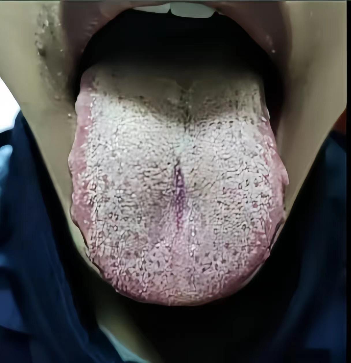 口苦口臭那点小问题硬是拖到伤阴了，当大夫的都不知道说啥……

今天这个患者主诉：