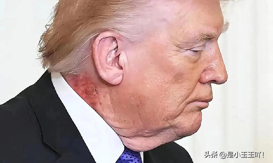 特朗普近几日几天被曝出可能生病了，网友们根据特朗普的脖子到手的瘀血症状，推测可能
