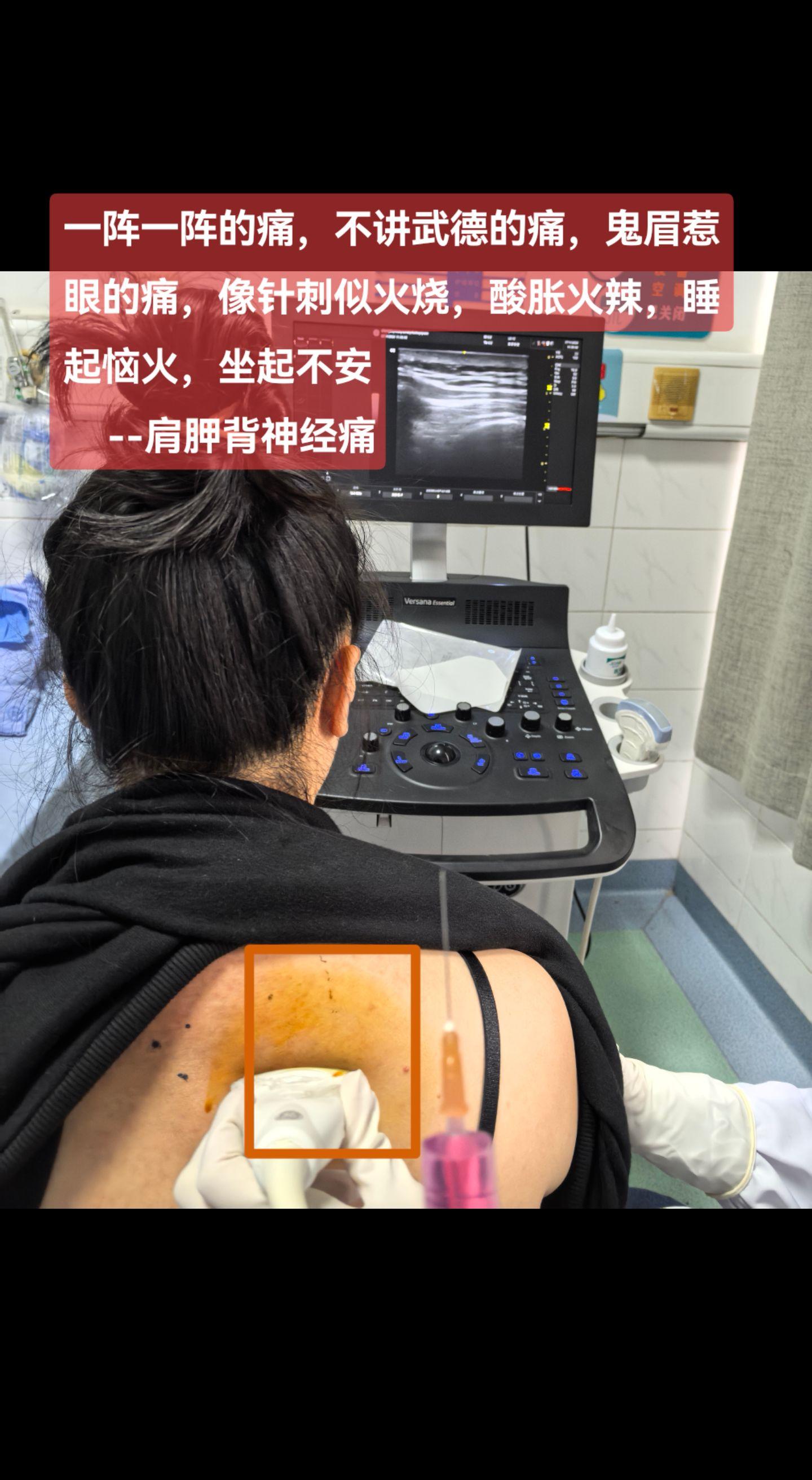 肩胛背神经痛，根源于颈5神经后支卡压刺激，常伴有同侧颈部疼痛和上肢放射痛