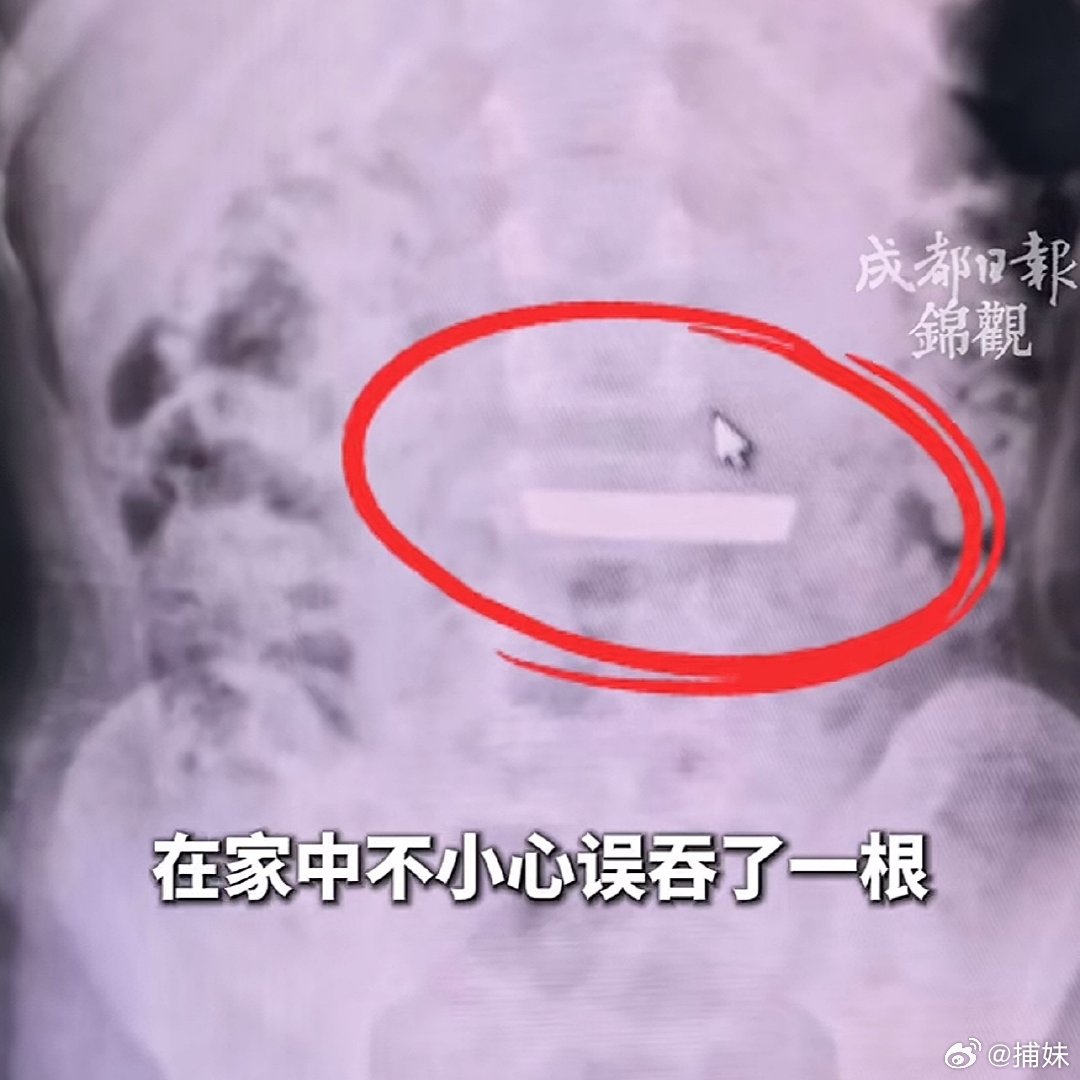 5岁女童不慎吞了50克金条这么大金条成人吞下去都费劲，5岁小孩怎么吞进去的？家长