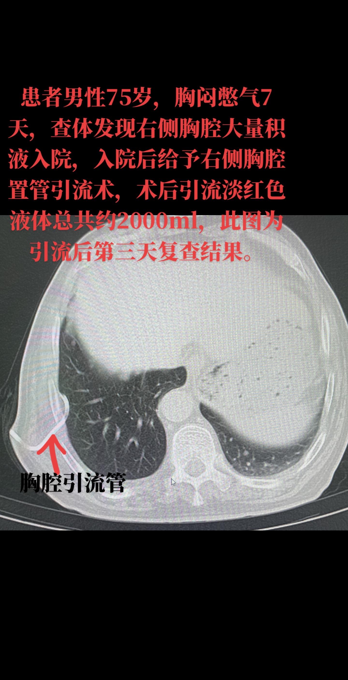 病例分享：右肺上叶腺癌，行CT引导下右肺上叶穿刺活检术，术后病理提示浸润性腺癌，考虑右肺上叶肿瘤系原发性恶性肿瘤。病理分期：右肺上叶腺癌，pT3N2M1，Ⅳ期。建议患者行基因检测，待基因检测回归后，行下一步治疗方案。