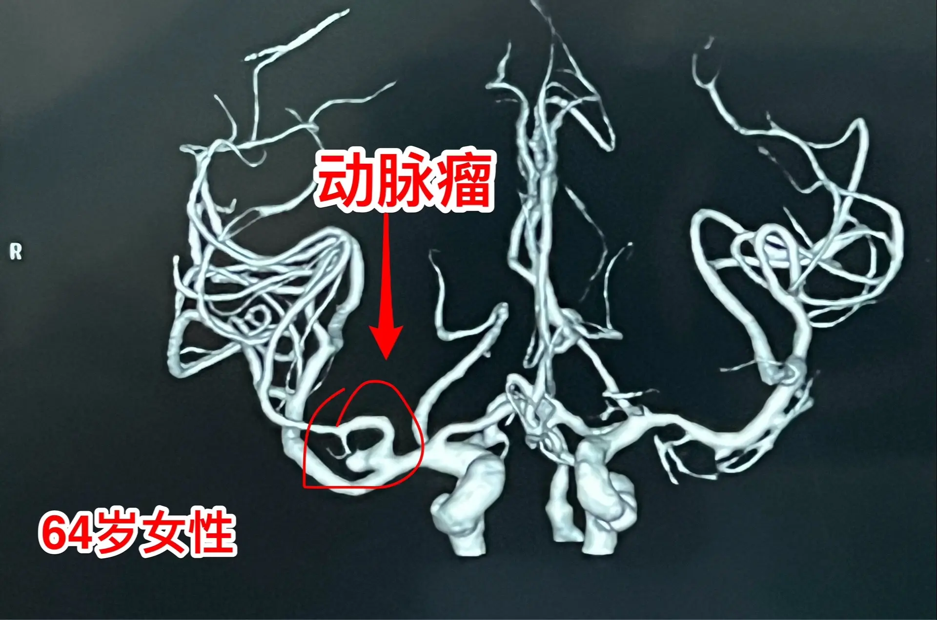 玉环市病人小脑出血后检查发现脑动脉瘤。64岁女性，浙江省玉环市人。4个...