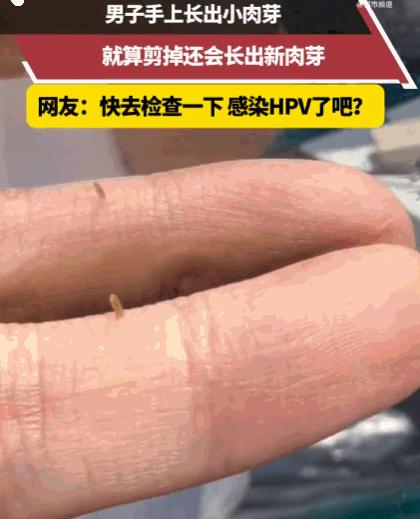 江苏，一男子看着手上那个不起眼的小肉芽，越看越碍眼，干脆心一横，找来工具“手起刀