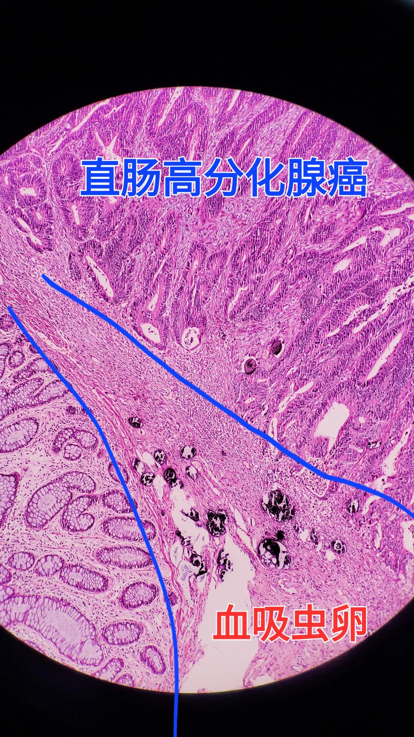 直肠癌 血吸虫病