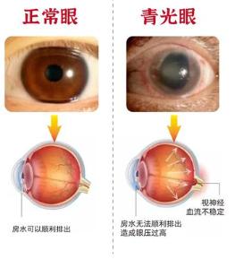 眼睛竟会悄悄失明？别等看不见才知道青光眼
眼睛竟会悄悄失明？别等看不见才知道青光