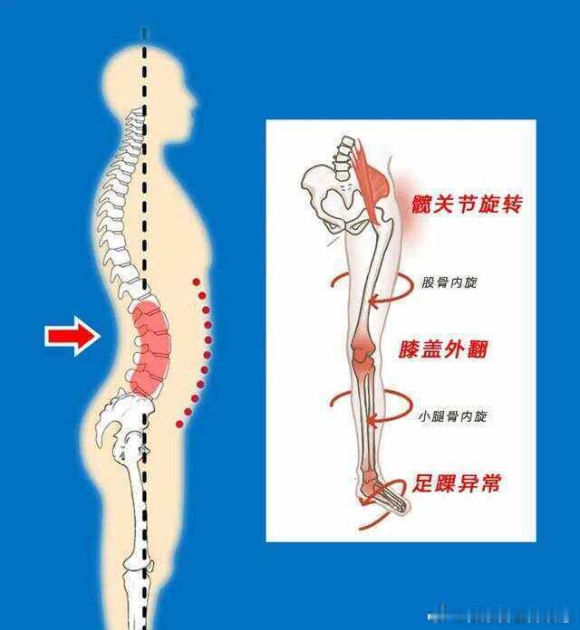 #小腹突出和腰痛都有救了##全民营养提升计划##健闻登顶计划# ‼️ 骨盆前倾有