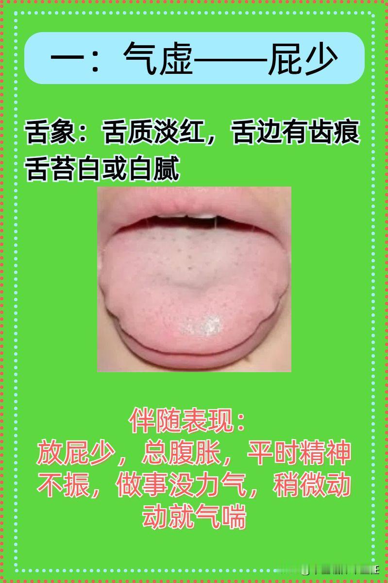 放屁识健康：这四种舌象应对四种排气状态，看看你是哪一种？

一：气虚——屁少
