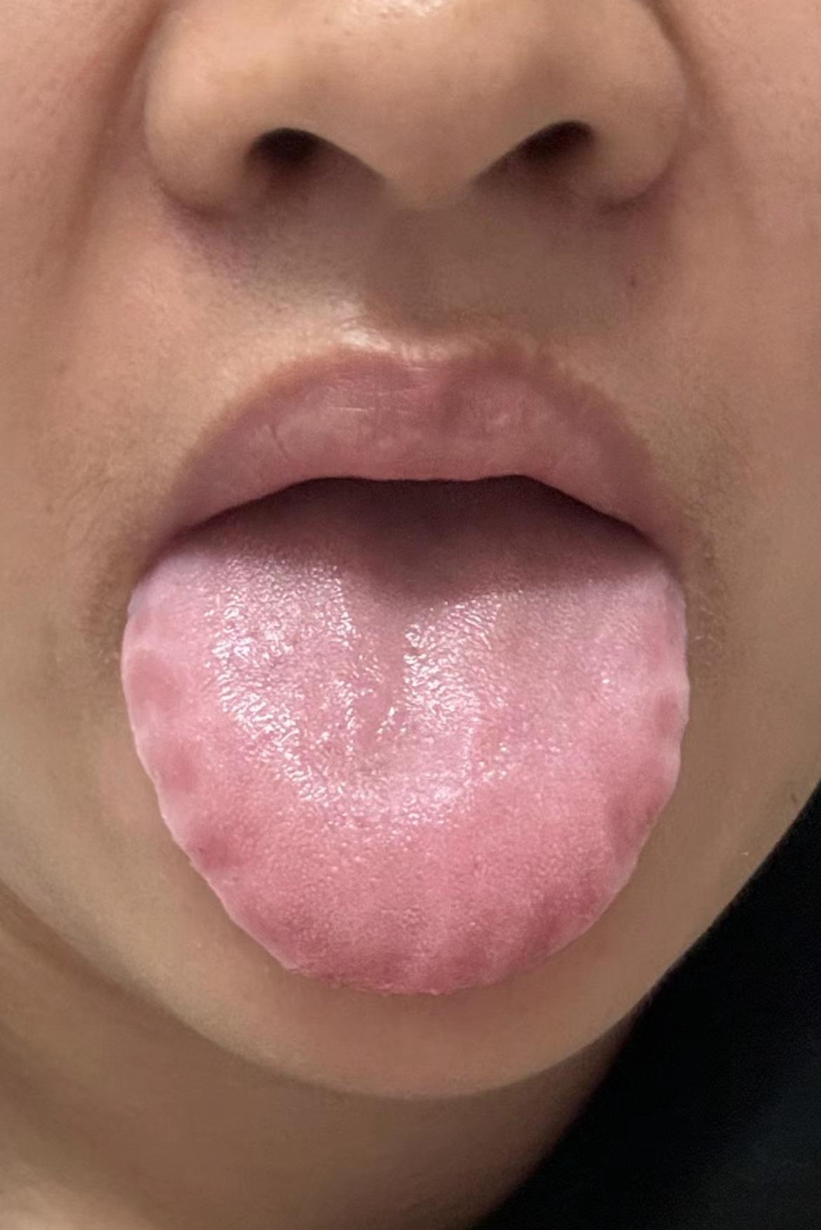 纯纯的大冤种[捂脸]，出现这种舌象，你别光指望喝药了
齿痕绕舌一圈，看着皱皱巴巴