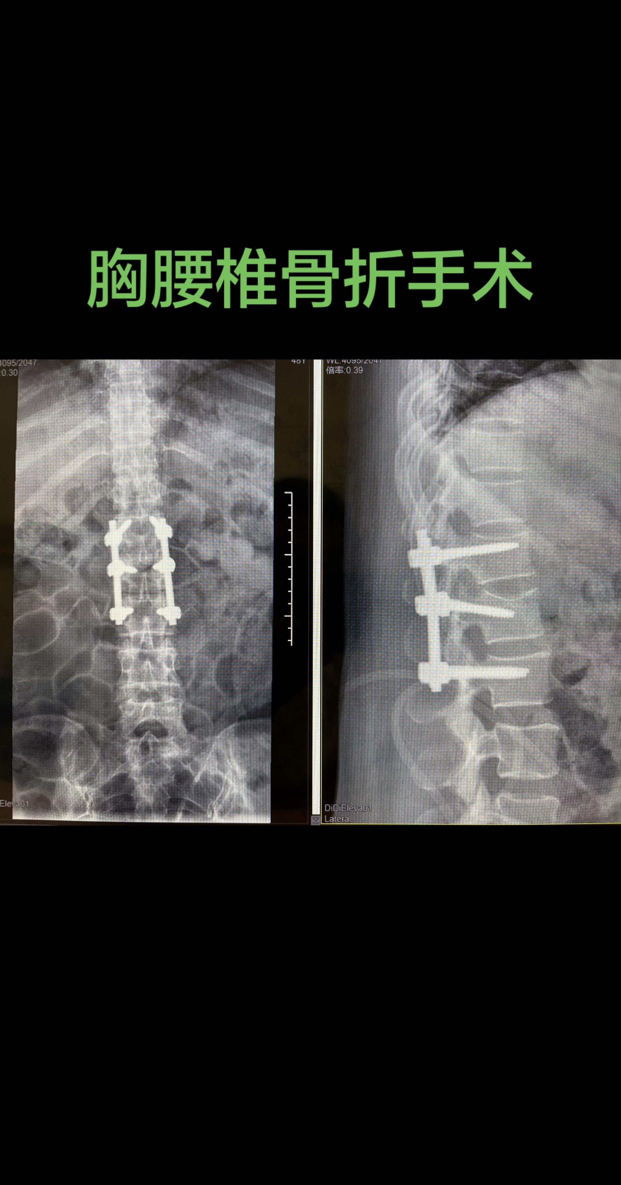 真正的微创。胸腰椎骨折，我仍然坚持不打经皮螺钉，而选择肌肉间隙入路，更...