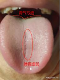 比肾虚更可怕的是脾肾两虚，虚就算了，还怎么也补不进去，该怎么调？
舌象分析：
舌
