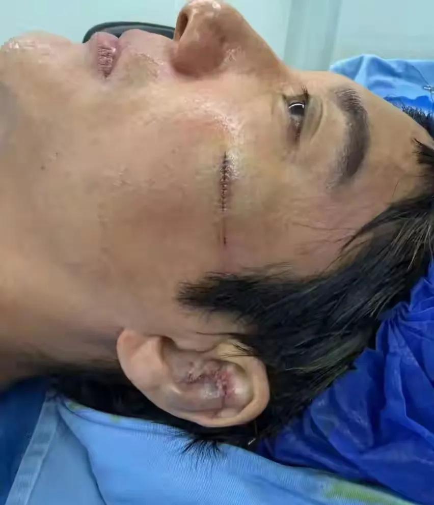 7月4日，王力宏登上热搜，世界巡回演唱会开启成都第二场被摔伤
7月4日晚，王力宏