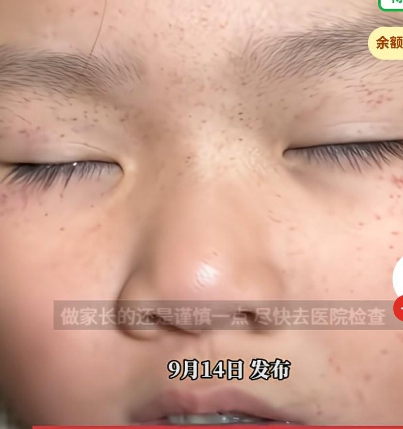 女孩半夜突然全身冒出了大量紫点，并且孩子看上去像是在做噩梦，
妈妈看的心急不已，