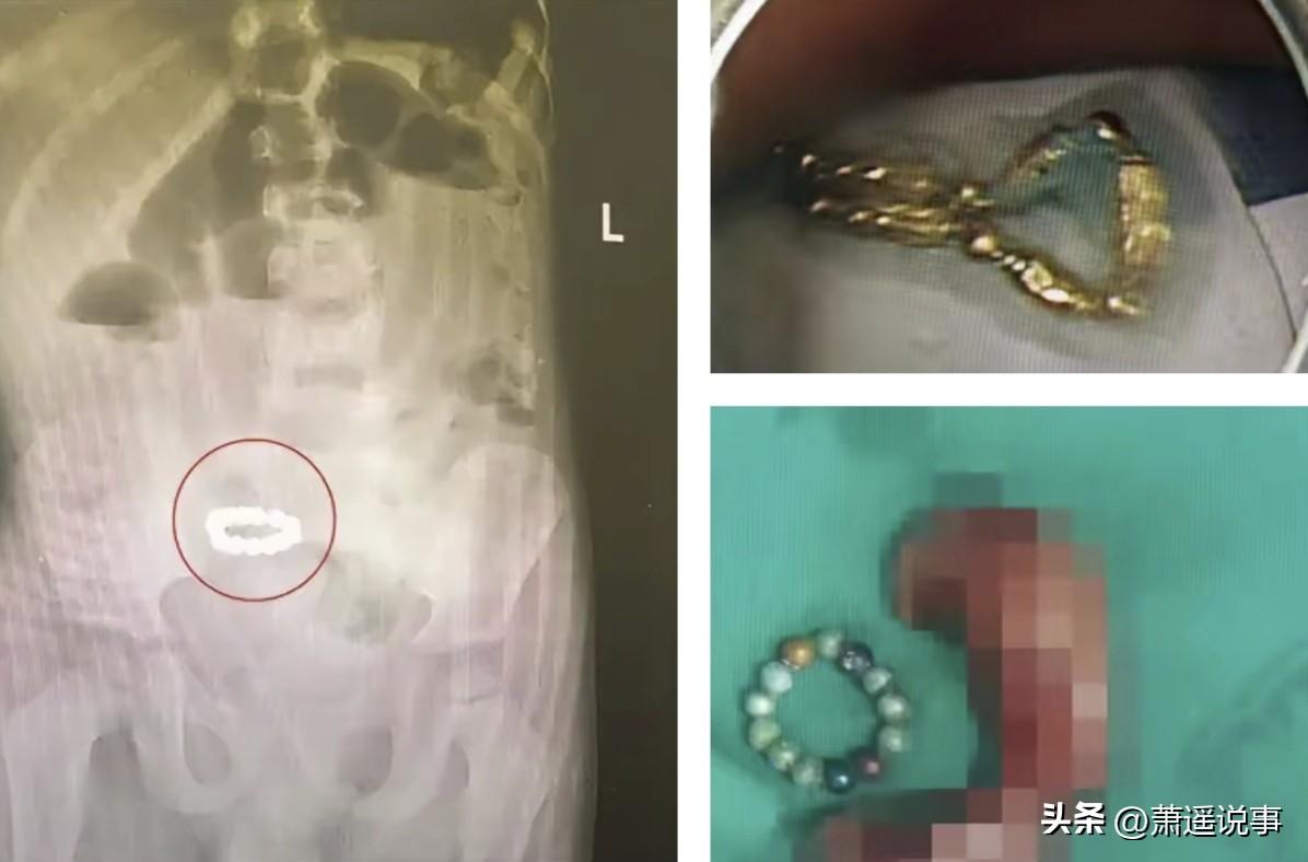 命都差点丢了，还要脸干嘛，深圳这位男子不仅肠子都悔青了，还不得不把坏掉的肠子给切