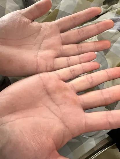 喝了一年"偏方"，36岁小伙查出多处癌变！别再拿身体试毒了。

小伙从小有白癜风