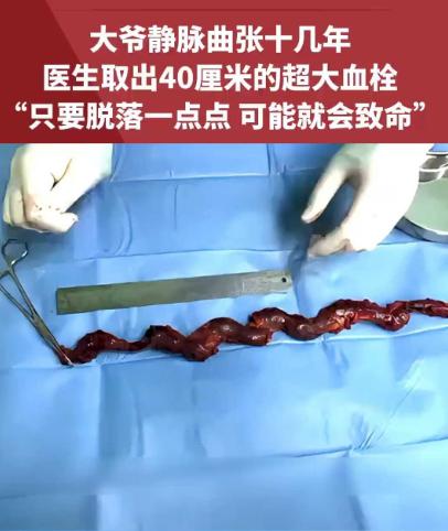 [衰]北京，一位患静脉曲张十几年的大爷，体内竟悄悄长出一条长达40厘米的巨大血栓