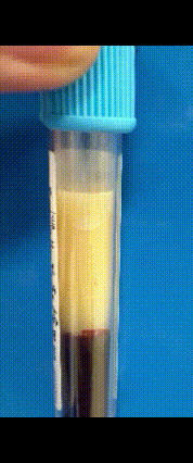 晨起这4个信号可得警惕！我叔前阵总说头晕、眼皮沉，手上还冒小疙瘩，以为是没睡好，