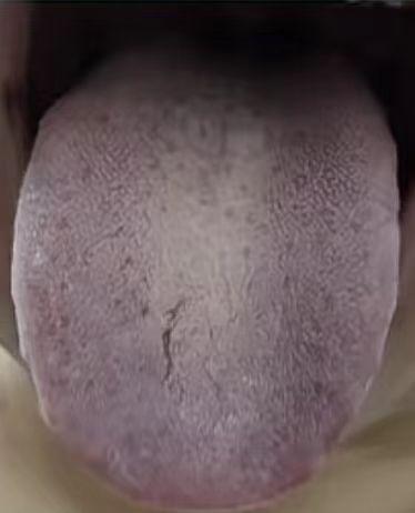 这种舌头，健脾化痰，疏肝补阳，远远不行。
患者主诉，脘腹胀满，胃口差，经常大便不