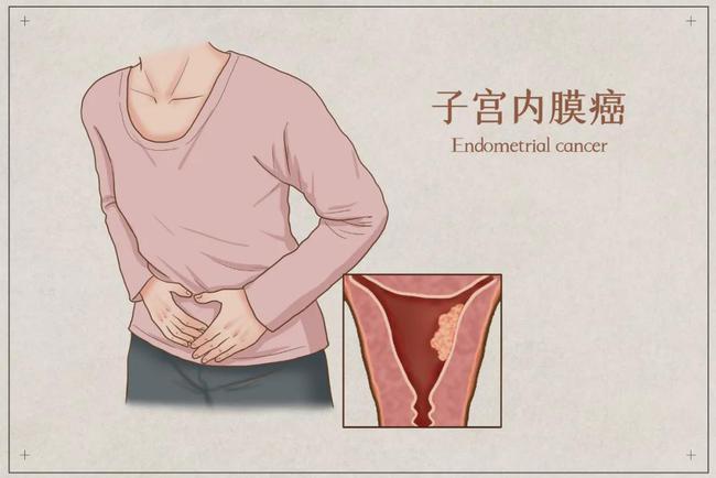 #健康真探社#【子宫内膜癌不切子宫，主要靠这几招】对于符合要求的早期子宫内膜癌，