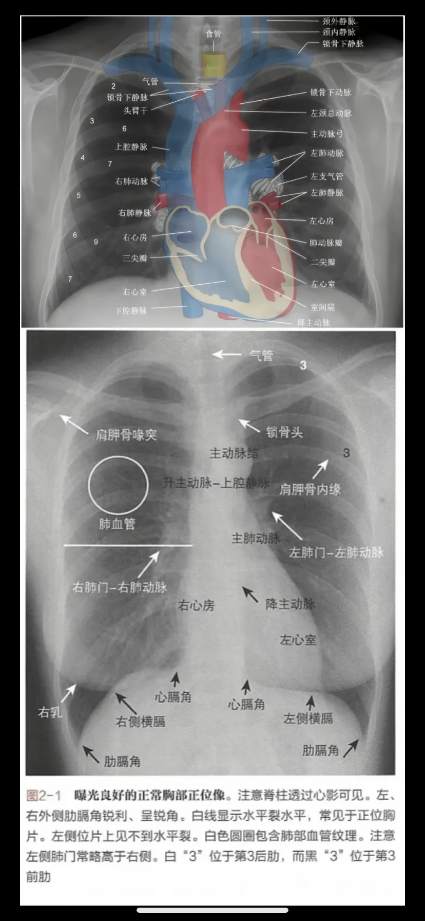今日学习——正位胸片