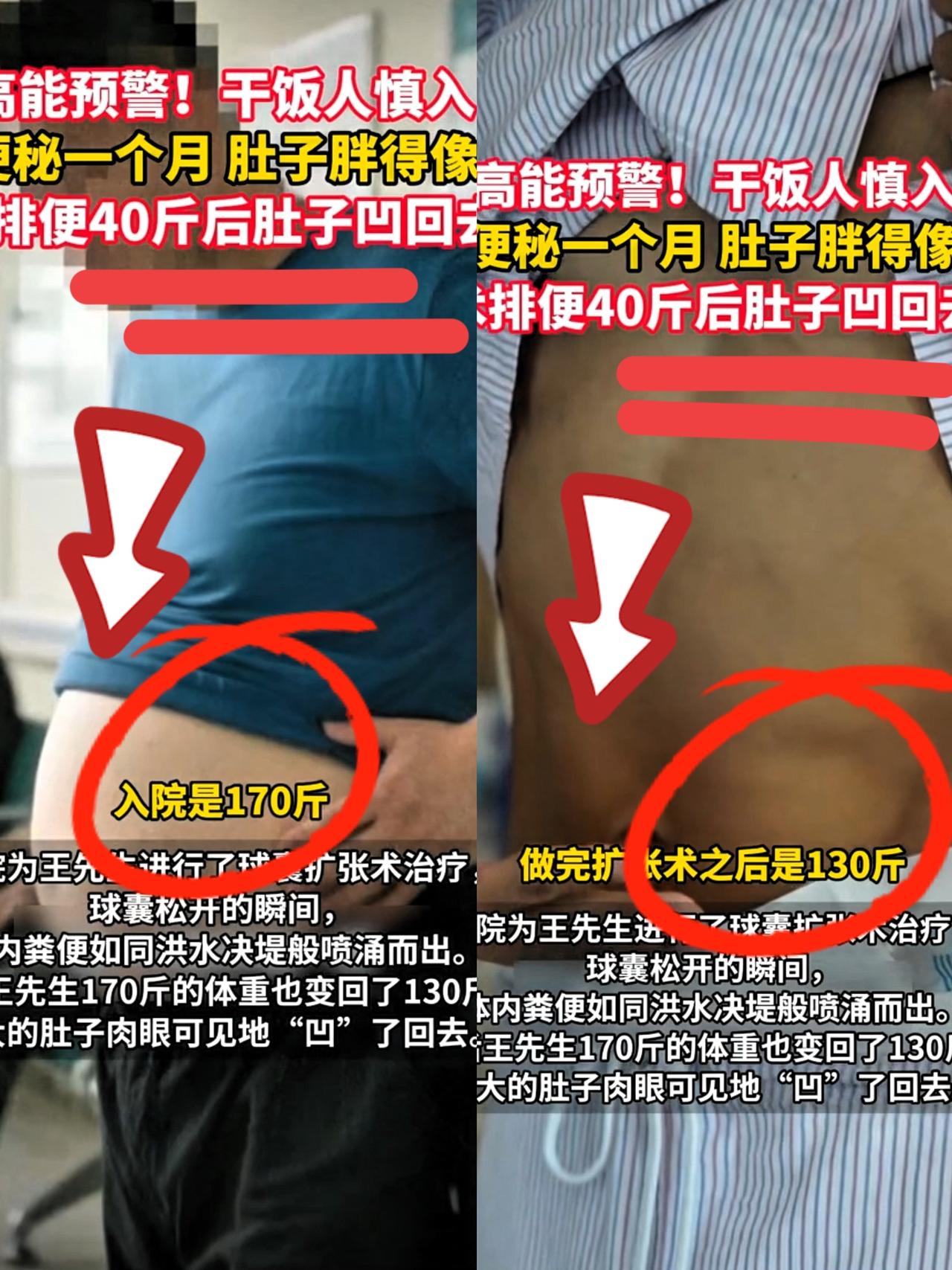 体内藏着40斤粪便！！！
体型像大青蛙🐸！！！
大家所谓的青蛙肚究竟是啥概念！