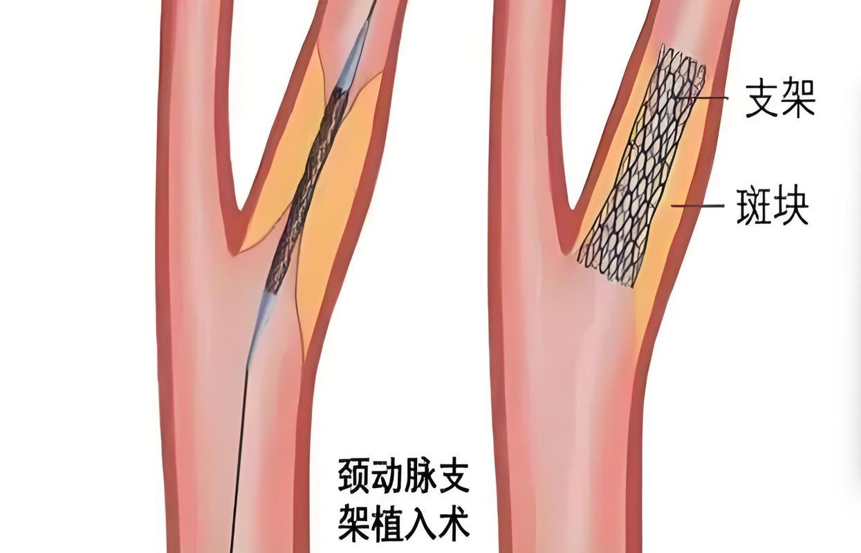 颈动脉支架术后，居家休养可得多上心
 
做完颈动脉支架手术出院回家，一定要老老实