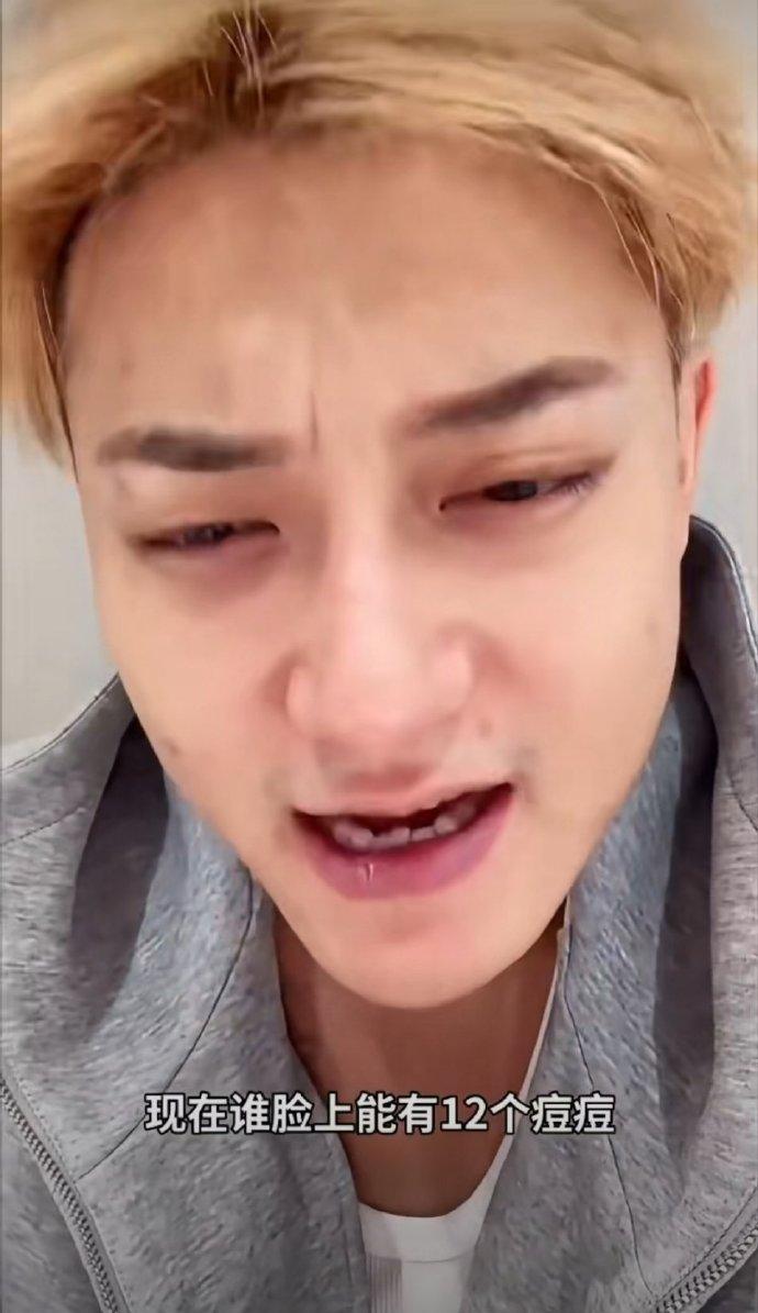 黄子韬直播太接地气了，无美颜无滤镜，细数脸上12颗痘，就问你“还有谁！＃