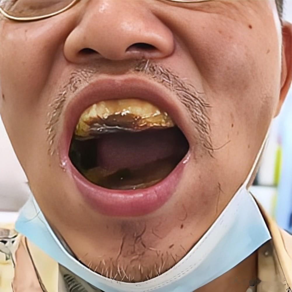 花5块钱自己补牙，男人把一口好牙彻底玩废了，觉得省钱是聪明，踩了世上最便宜的坑。