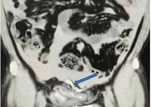 广州一男子被拳击后饮酒憋尿导致膀胱破裂，膀胱开口5厘米，肠道被尿液浸泡

近日，