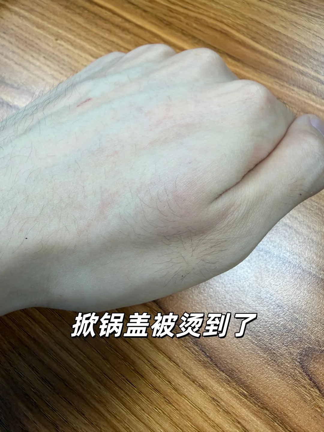 做饭烫到手处理过程及用到的东西