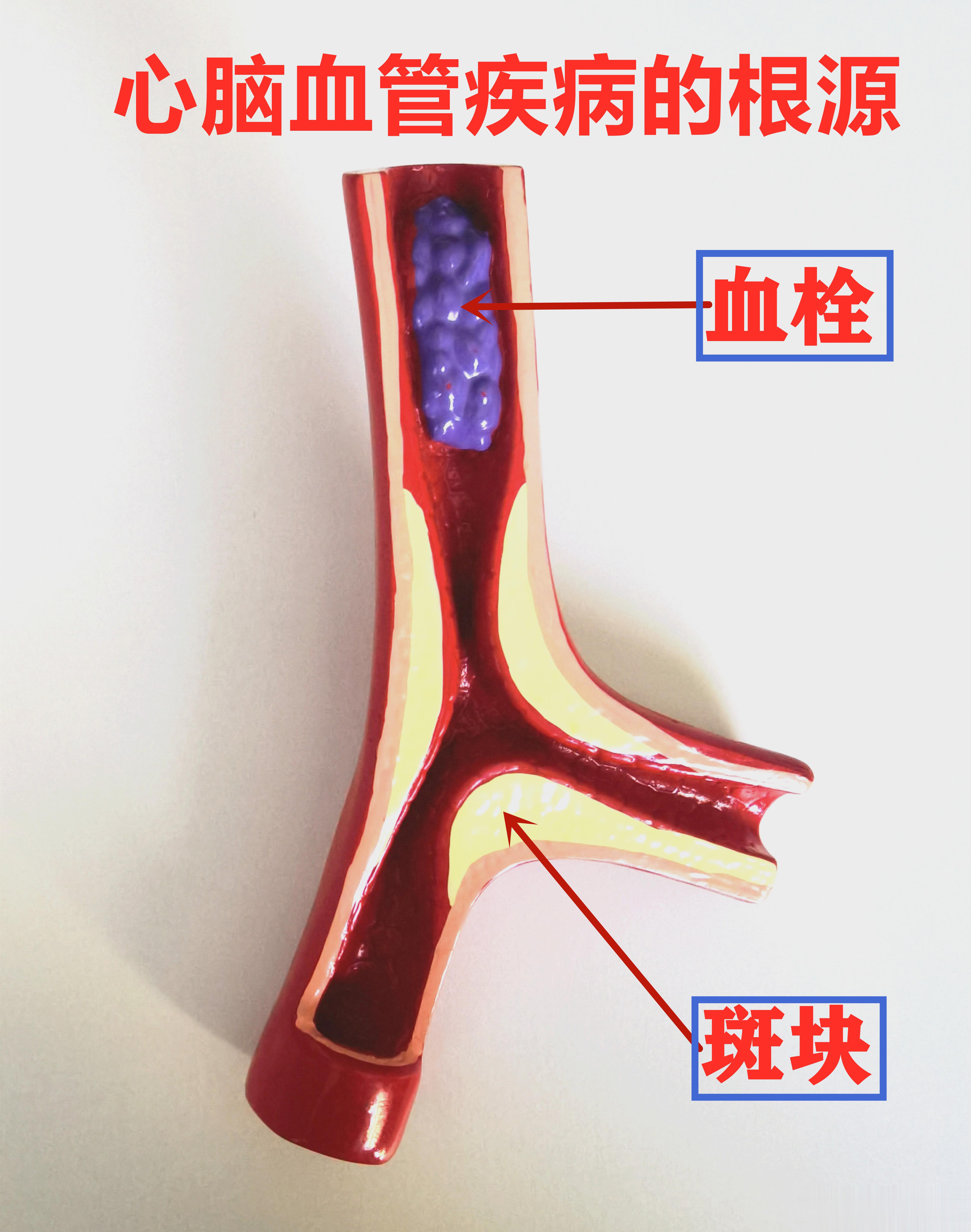 ⚫致使血管狭窄的原因是脂质斑块形成⁉️形成脂质斑块的根源又是什么🔷血脂异常是斑