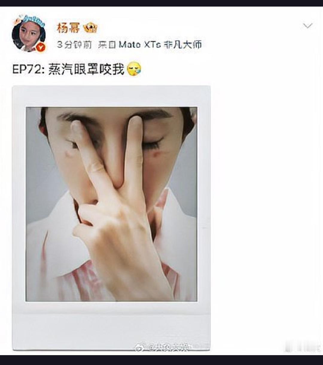 杨幂竟被蒸汽眼罩“咬”了？眼部烫伤引发热议，蒸汽眼罩真的是护眼神器吗？
4月27