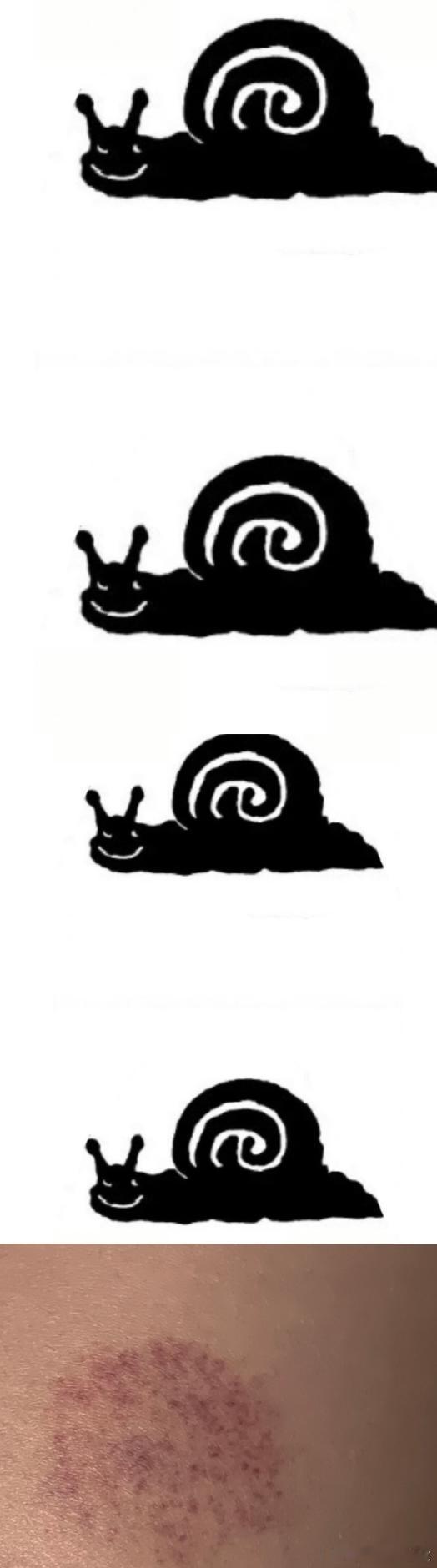 四张防窥，被蚊子咬出包，包消掉之后 ​​​