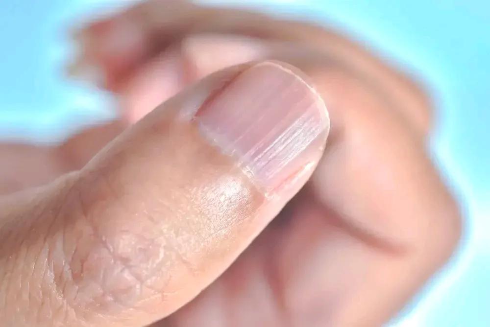 指甲上的竖纹：揭秘肝血虚的健康信号

在日常生活中，我们或许曾不经意间注意到指甲