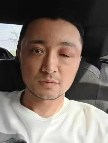 爱美之心人皆有之，但前提是一定不要伤害到自己的身体！主持人尼格买提晒出自己眼部肿