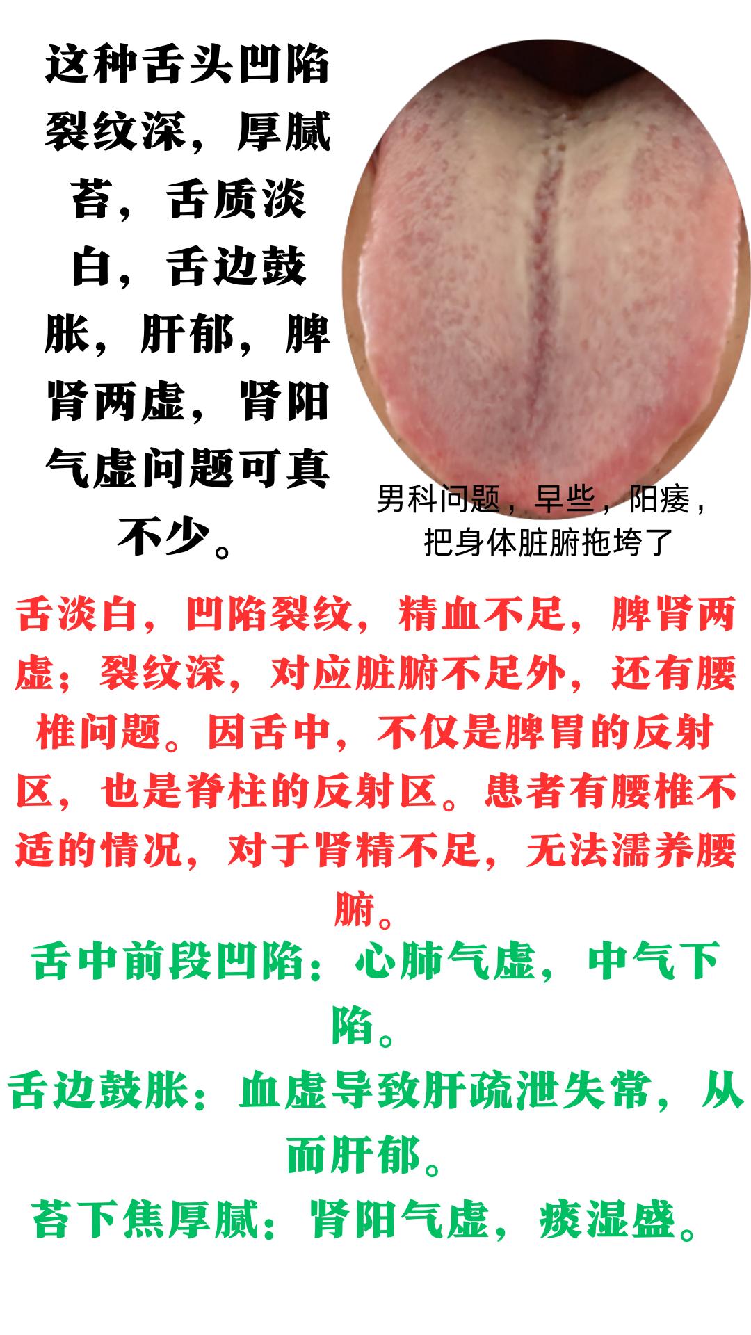 这种裂纹舌象，肝郁,脾肾两虚,肾阳气虚问题可真

这个患者脸色萎黄,胸闷气短,头