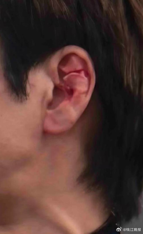 #王力宏耳骨明显撕裂#【王力宏成都演唱会不慎绊倒，脑袋磕上台阶耳骨明显撕裂】7月