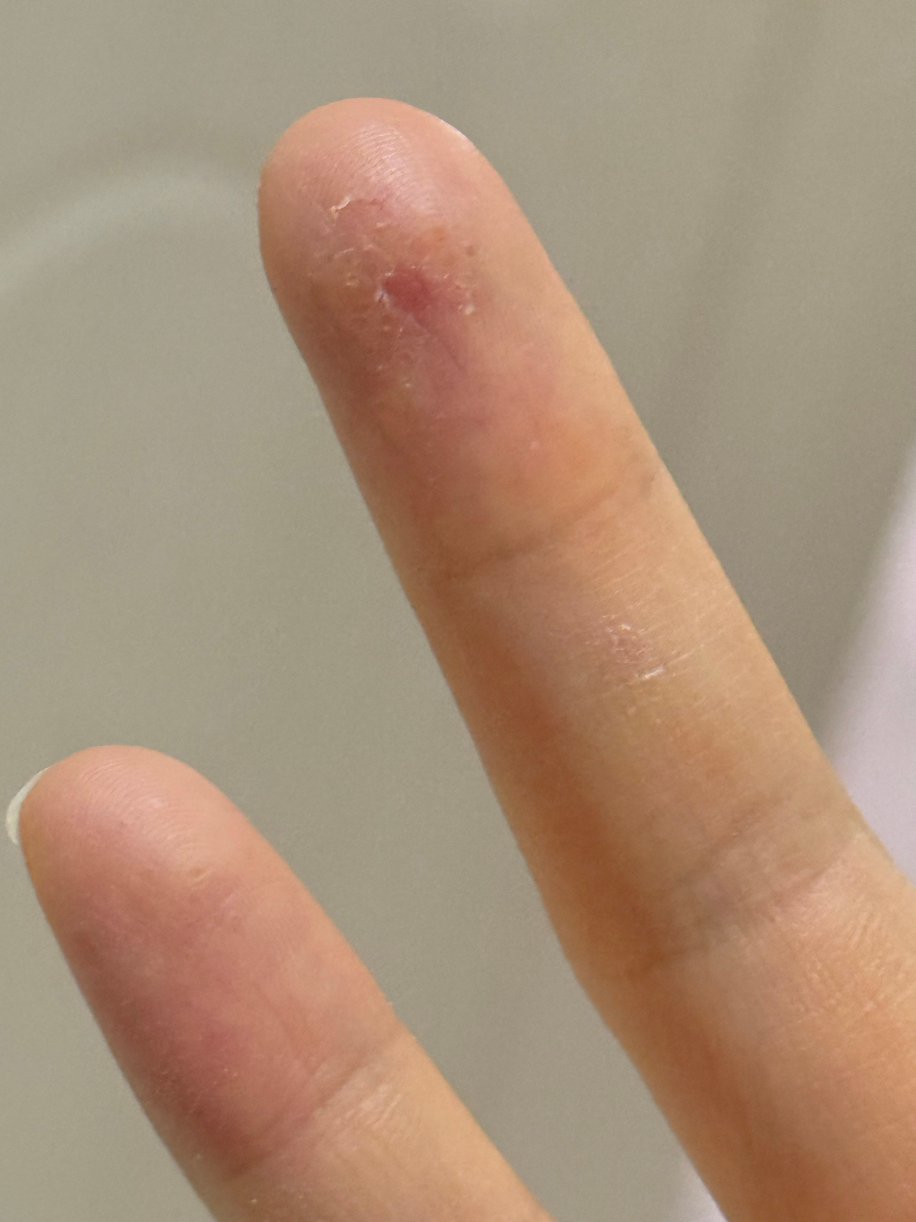 我一到北方我的手就这样  我真的没办法了。都没办法提东西，因为你们看到那个深色的