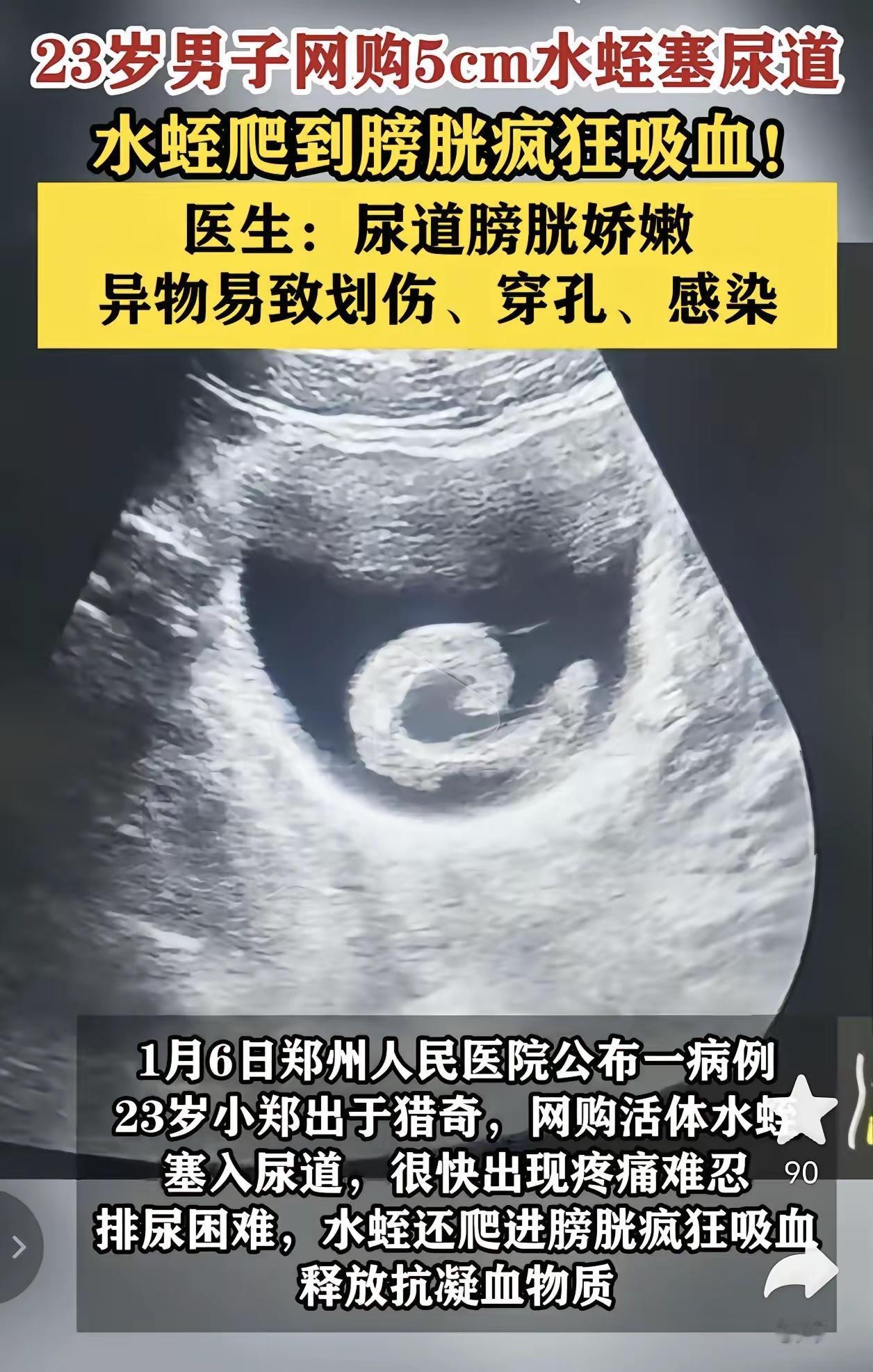 河南郑州，一23岁男子出于好奇，网购5cm的水蛭塞入尿道，很快腹痛难忍，排尿困难