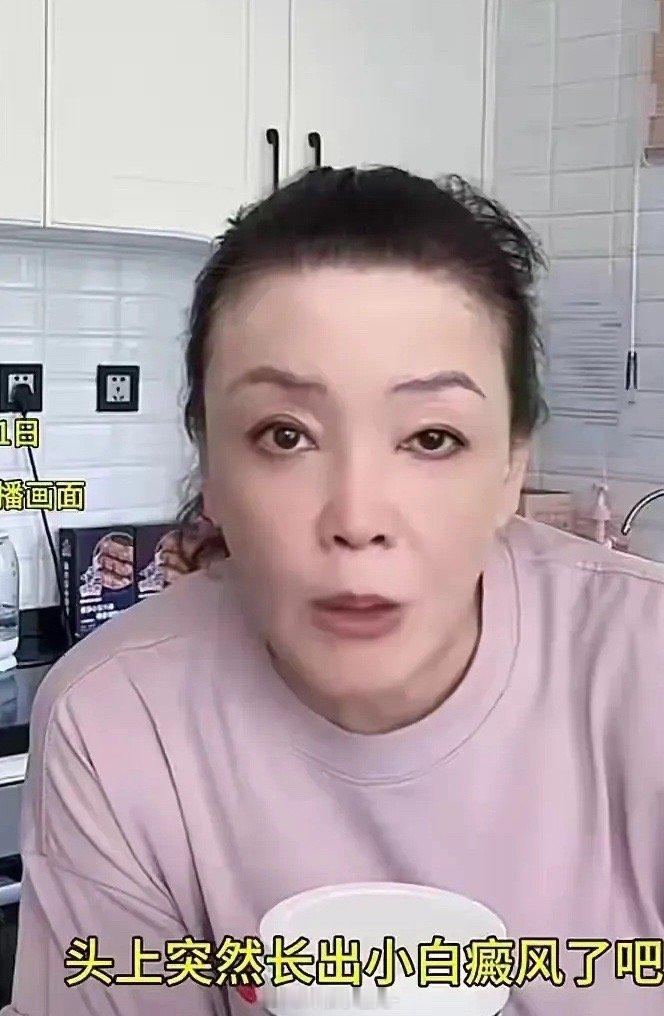 张兰在直播间介绍化妆品的时候，张兰就大方承认自己长白癜风了！张兰说，脖子上，额头