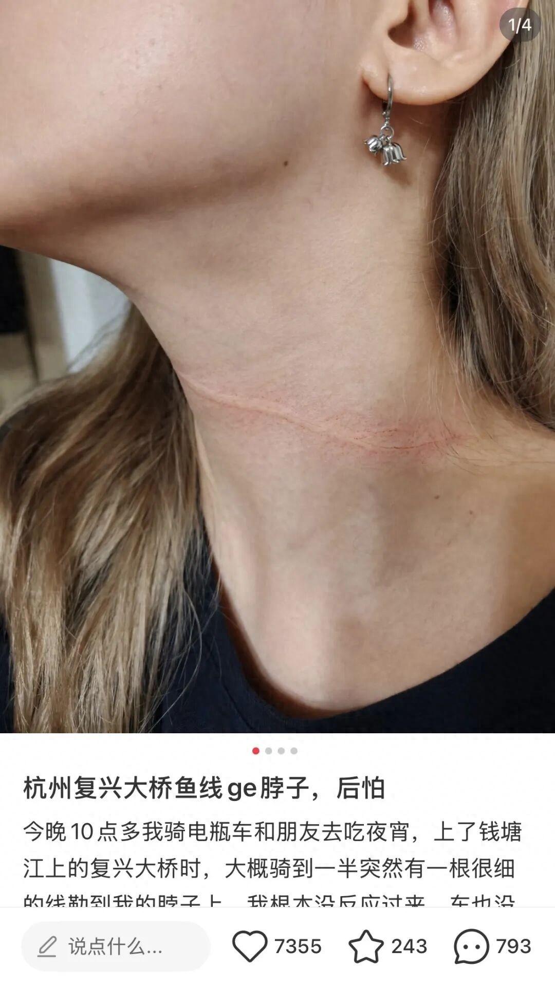 杭州姑娘夜骑大桥，脖子被一根细线勒出红痕，差一点就伤到喉管！

这事发生在5月下