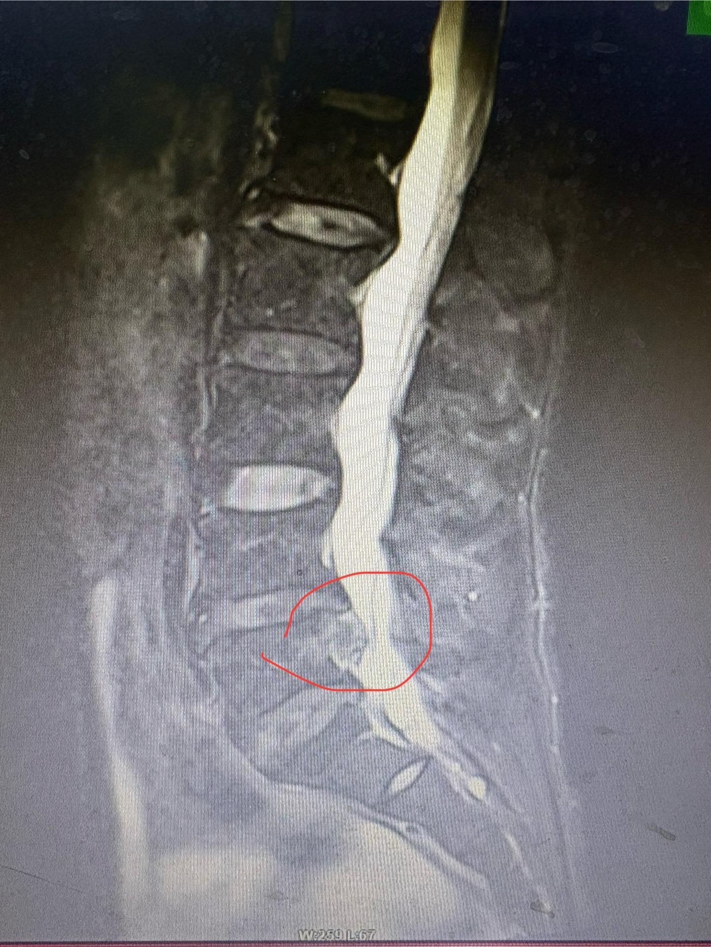 大部分椎间盘突出都是可以保守治疗的。极少部分病人如果保守治疗无效也是可...