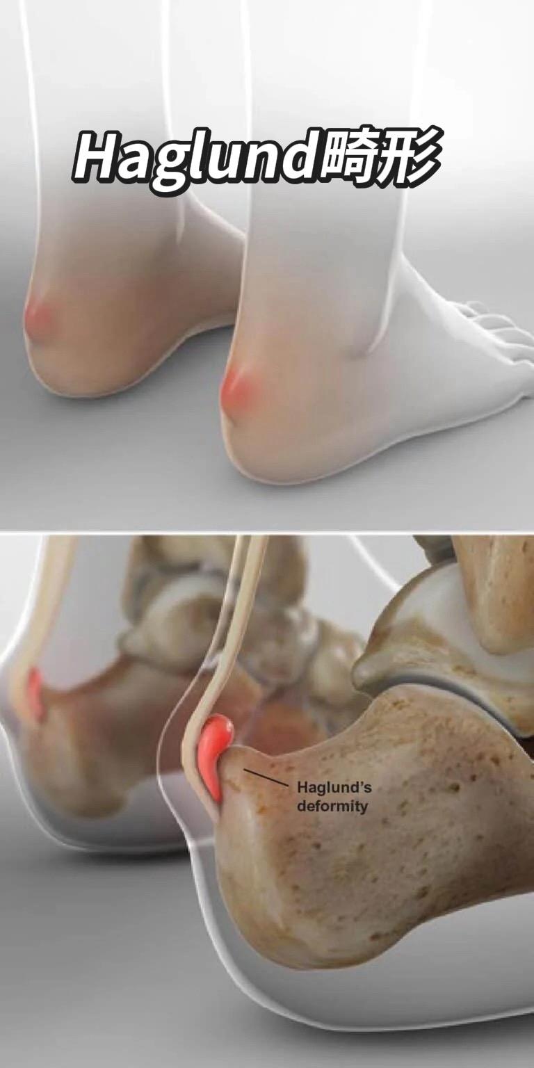 Haglund畸形。是一种足跟部的骨骼异常。它指的是脚后跟骨后上方边缘...